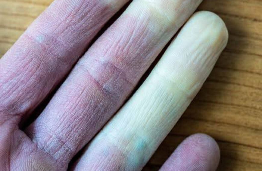 Warum ändern die Finger ihre Farbe