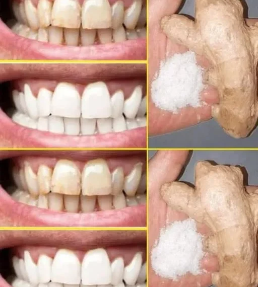 Bleichen Sie Ihre Zähne sofort mit diesem 2-minütigen Ingwer-Salz-Trick auf. So geht’s