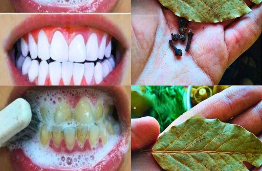Wie kann man Zähne mit Nelken und Lorbeerblättern aufhellen