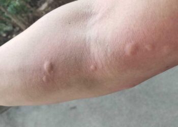 Mein Vater hat mir diesen Trick beigebracht, um Mückenstiche in nur 1 Minute ohne Nebenwirkungen zu stoppen. So funktioniert es