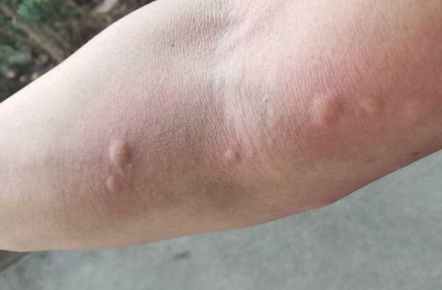 Mein Vater hat mir diesen Trick beigebracht, um Mückenstiche in nur 1 Minute ohne Nebenwirkungen zu stoppen. So funktioniert es