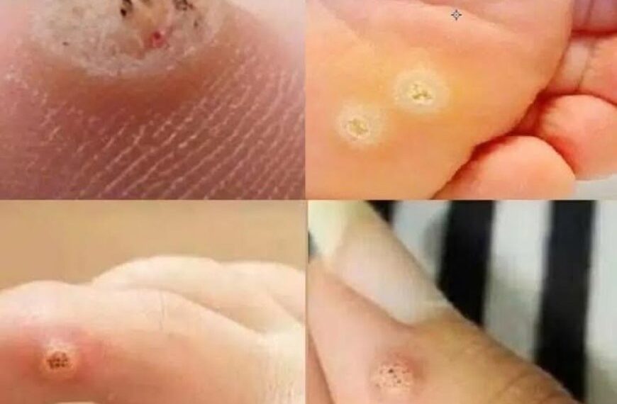 Seien Sie sehr vorsichtig: Wenn Sie dieses Wachstum auf Ihrer Haut bemerken, kann es ernst sein