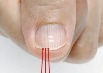 Was die vertikalen Linien auf Ihren Nägeln wirklich verratenn