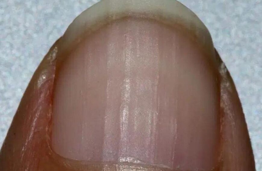 Wenn Sie Rillen auf Ihren Nägeln haben, sagt das etwas über Ihre Gesundheit aus