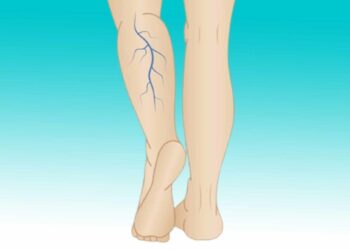 Wenn Sie violette Adern an den Beinen haben, bedeutet das, dass Sie…