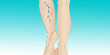 Wenn Sie violette Adern an den Beinen haben, bedeutet das, dass Sie…