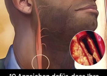 10 Anzeichen, um verstopfte Arterien zu erkennen