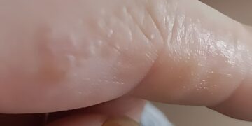 Das sind diese kleinen juckenden Beulen an deinen Fingern